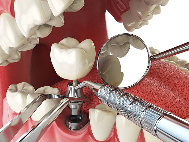 Best Emergency Root Canal Treatment in Reno, OH